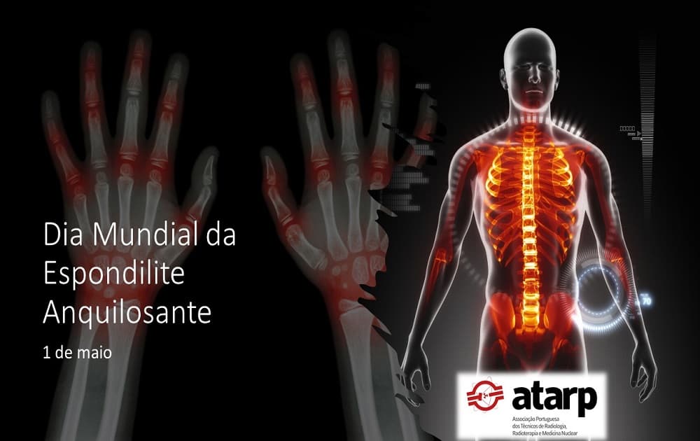 Dia Mundial da Espondilose Anquilosante